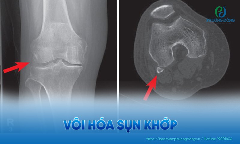 Vôi hóa sụn khớp: Triệu chứng, nguyên nhân và hướng điều trị