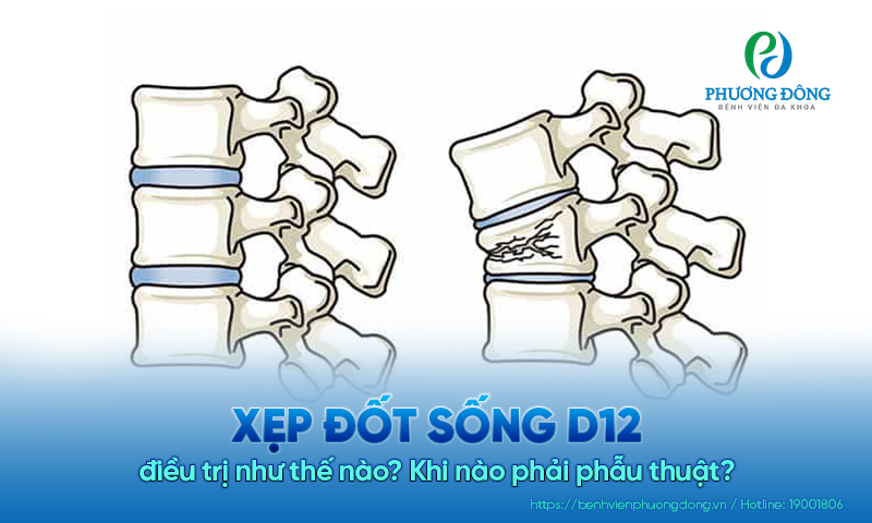 Xẹp đốt sống D12 điều trị như thế nào? Khi nào phải phẫu thuật?