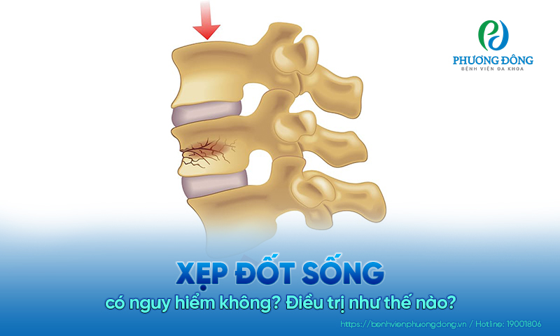 Xẹp đốt sống có nguy hiểm không? Điều trị như thế nào?