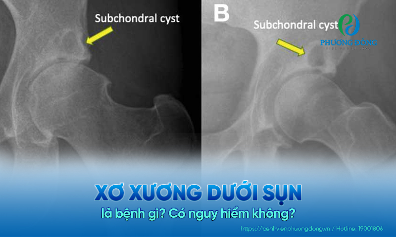 Xơ xương dưới sụn lả bệnh gì? Có nguy hiểm không?