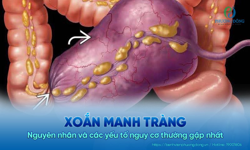 Xoắn manh tràng: Nguyên nhân và các yếu tố nguy cơ thường gặp nhất