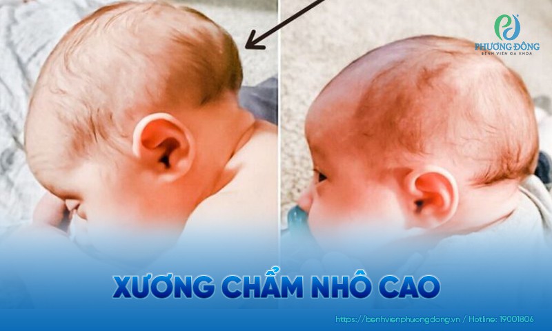 Xương chẩm nhô cao ở trẻ sơ sinh bình thường và nguy hiểm khi nào?