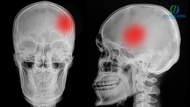 Vỡ xương sọ là một trong những dạng chấn thương nghiêm trọng