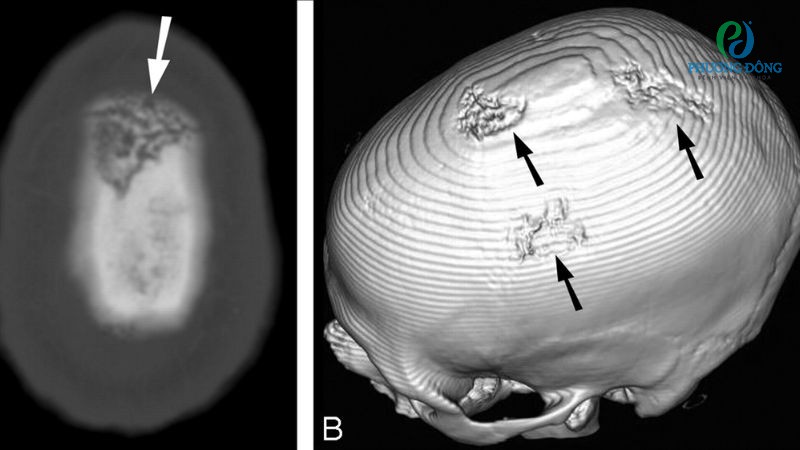 Viêm xương sọ khởi phát do tình trạng nhiễm khuẩn, nhiễm nấm