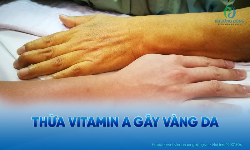 Thừa vitamin A gây vàng da