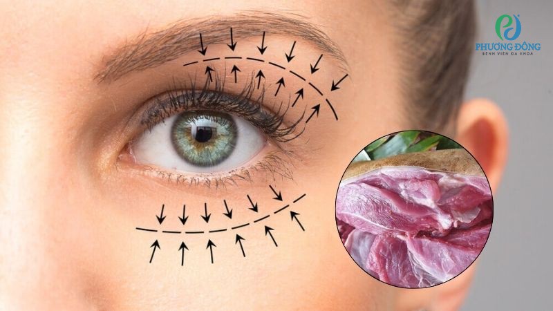 Hỏi - Đáp cùng bác sĩ: Cắt mí mắt có ăn được thịt dê không?