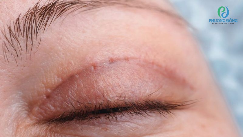 Bác sĩ Nhãn khoa trả lời: Cơ địa sẹo lồi có cắt mí mắt được không?