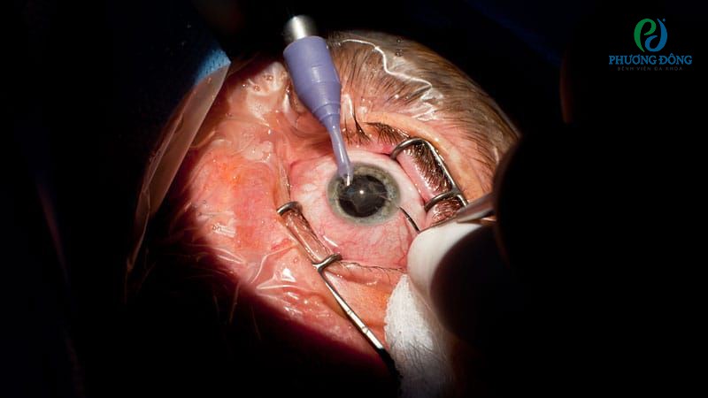 Bệnh nhân mắc tật khúc xạ có thể nhận chỉ định mổ mắt