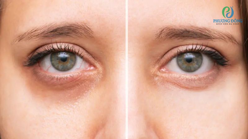 Tiêm tan quầng thâm mắt chỉ phù hợp với tình trạng da lão hóa, thiếu hụt mô mềm, tuần hoàn máu kém