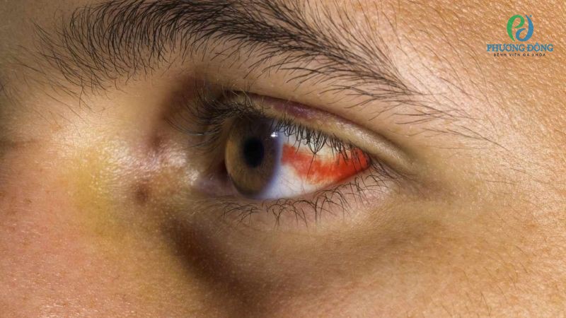 Giải đáp cùng bác sĩ: Làm sao để mắt hết nổi gân đỏ?