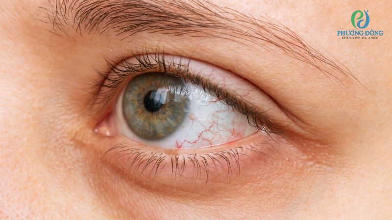 Nghỉ ngơi, ngủ đủ giấc, tránh dùng thiết bị điện tử để mắt không bị nổi gân đỏ thường xuyên