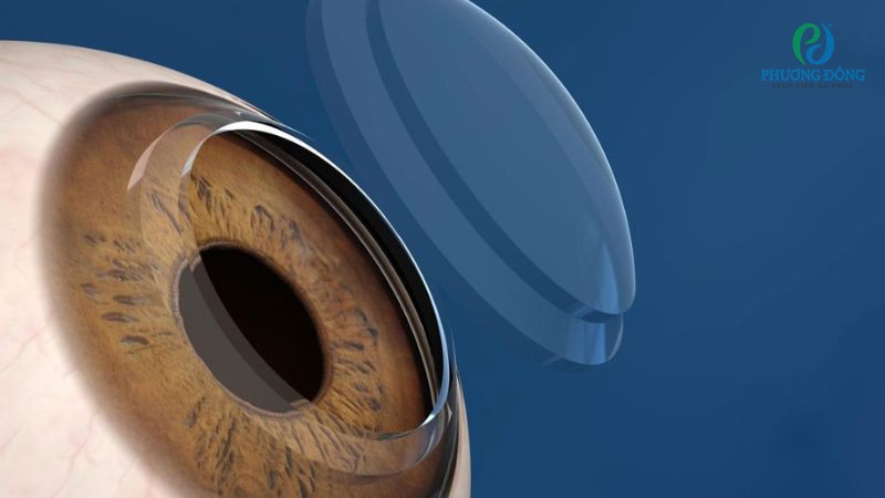 Độ dày giác mạc không thể tự tăng lên bằng cách thay đổi chế độ dinh dưỡng hay sinh hoạt