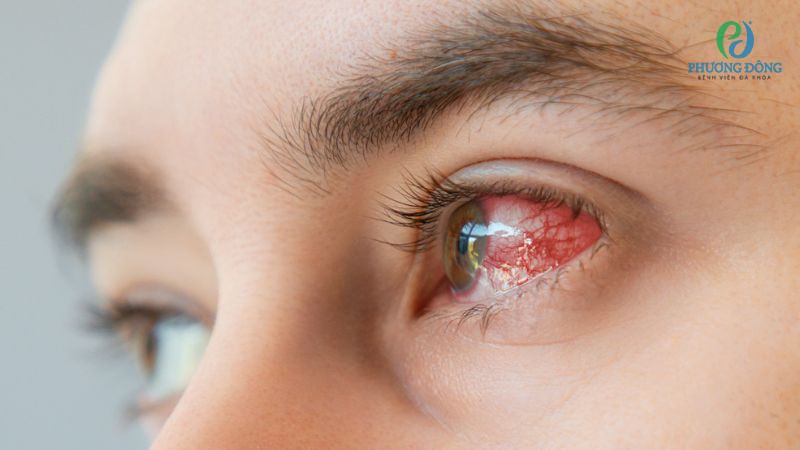 Giác mạc tổn thương nhẹ có thể tự hồi phục sau vài ngày chăm sóc tại nhà