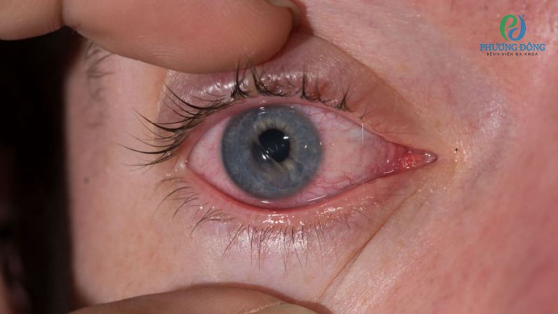 Giải đáp cùng bác sĩ: Giác mạc có tự lành không?