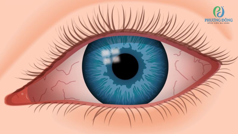 Khô giác mạc có thể cải thiện, điều trị dứt điểm nếu can thiệp sớm