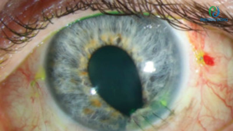 Thủng giác mạc không được điều trị có thể dẫn đến những biến chứng nguy hiểm cho sức khoẻ