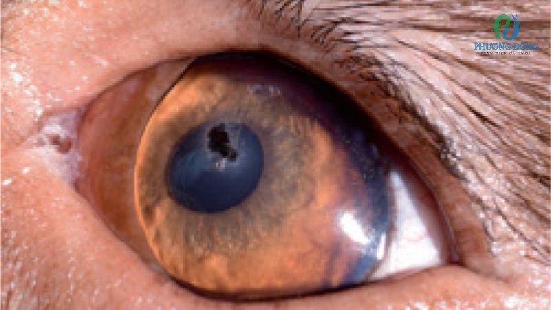 Giải đáp cùng bác sĩ Nhãn khoa: Thủng giác mạc có nguy hiểm không?