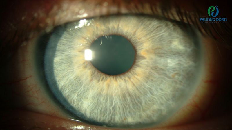 Viêm giác mạc chấm nông có lây hay không phụ thuộc phần lớn vào nguyên nhân gây bệnh