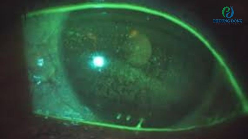 Bác sĩ Nhãn khoa giải đáp: Viêm giác mạc chấm nông có lây không?