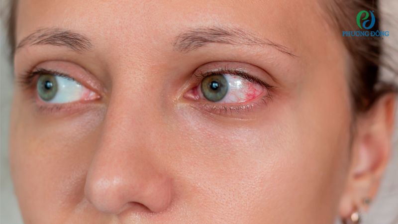 Viêm giác mạc do virus, vi khuẩn có thể lây lan ra ngoài cộng đồng