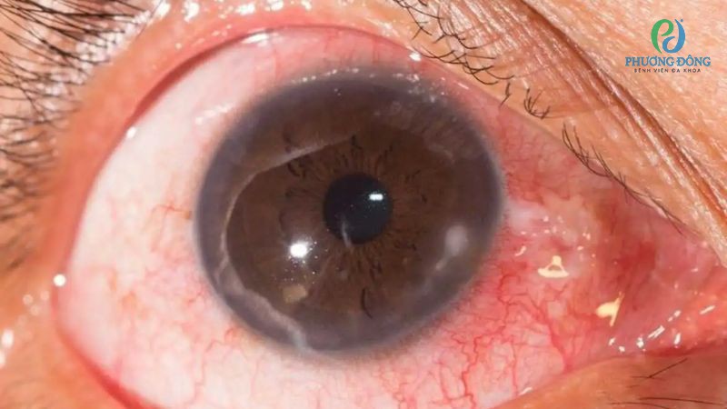 Giải đáp cùng bác sĩ: Viêm giác mạc có bị lây không?