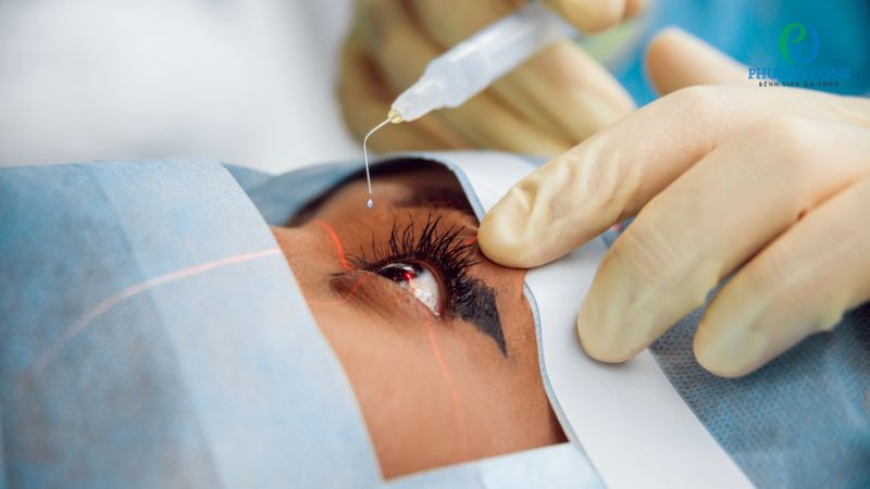 Phần lớn các trường hợp viêm giác mạc không cần xử trí ngoại khoa