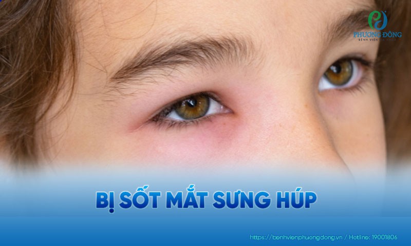 Trẻ bị sốt mắt sưng húp: Nguyên nhân, triệu chứng và điều trị