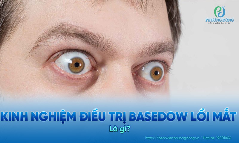Kinh nghiệm điều trị basedow lồi mắt. Dấu hiệu và chẩn đoán