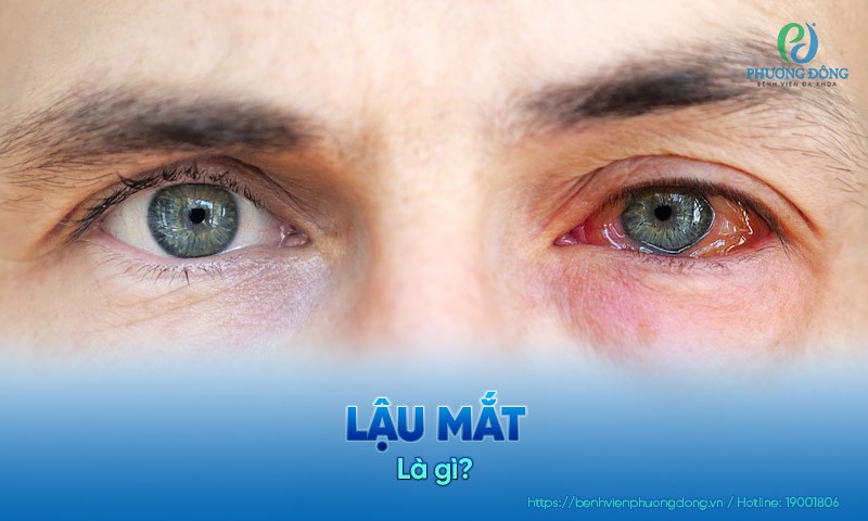 Lậu mắt: Nguyên nhân, dấu hiệu và phòng ngừa