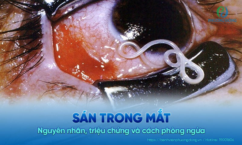 Sán trong mắt: Nguyên nhân, triệu chứng và cách phòng ngừa