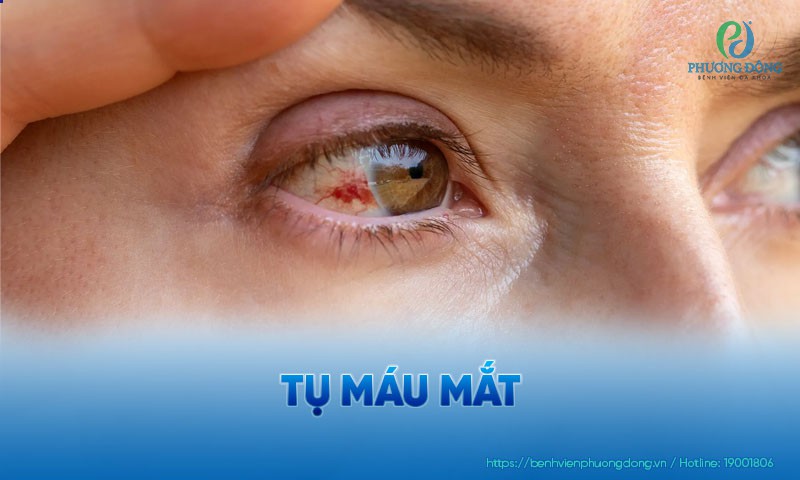 Tụ máu mắt: Nguyên nhân, dấu hiệu và hướng điều trị
