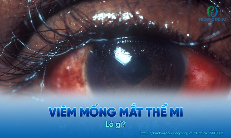 Viêm mống mắt thể mi: Nguyên nhân, triệu chứng và hướng điều trị