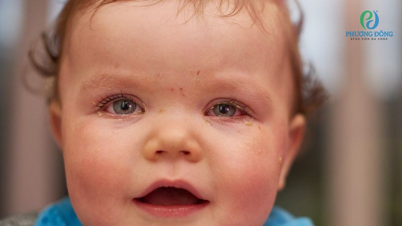 Nhận diện tác nhân khiến trẻ nhỏ bị viêm kết mạc mắt dẫn đến đổ ghèn