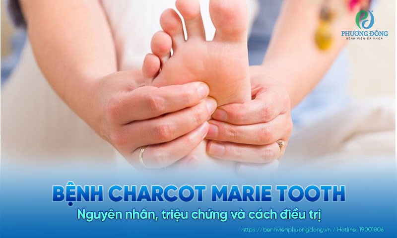 Bệnh Charcot Marie Tooth: Nguyên nhân, triệu chứng và cách điều trị