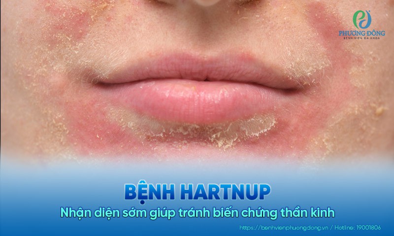 Bệnh Hartnup: Nhận diện sớm giúp tránh biến chứng thần kinh