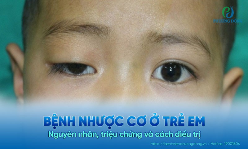 Bệnh nhược cơ ở trẻ em: Nguyên nhân, triệu chứng và cách điều trị