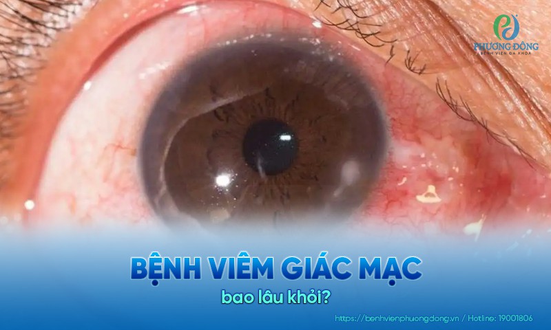Bệnh viêm giác mạc bao lâu khỏi? Thời gian hồi phục và cách điều trị