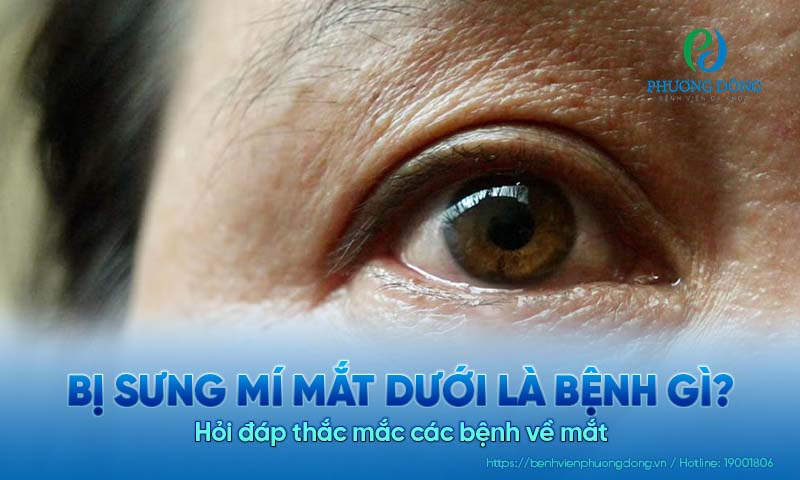 Hỏi đáp thắc mắc các bệnh về mắt: Bị sưng mí mắt dưới là bệnh gì?