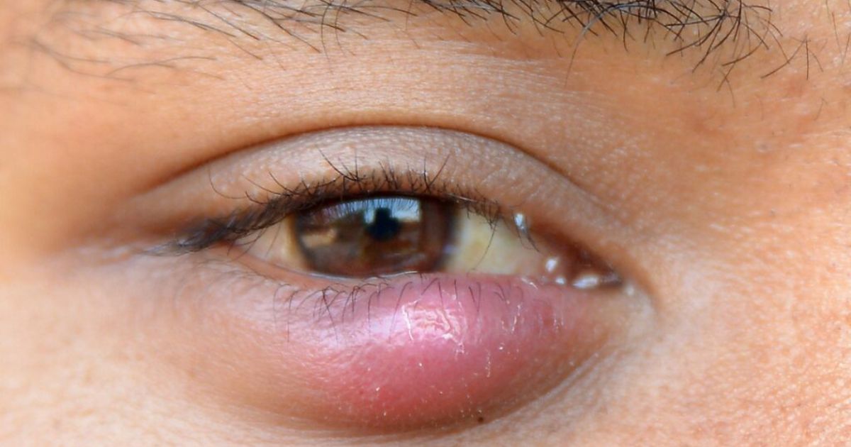 Lẹo mắt là một trong số những lý do người bệnh bị sưng mí mắt dưới 