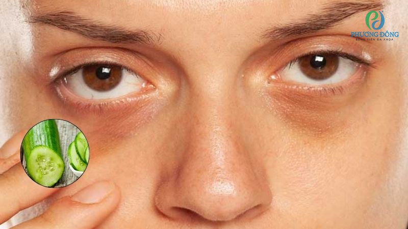Bị thâm quầng mắt nên ăn gì? Người bị thâm quầng mắt nên ăn dưa chuột