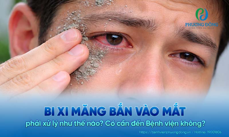 Bị xi măng bắn vào mắt phải xử lý như thế nào? Có cần đến Bệnh viện không?