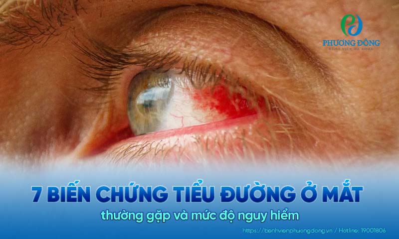 7 Biến chứng tiểu đường ở mắt thường gặp và mức độ nguy hiểm 