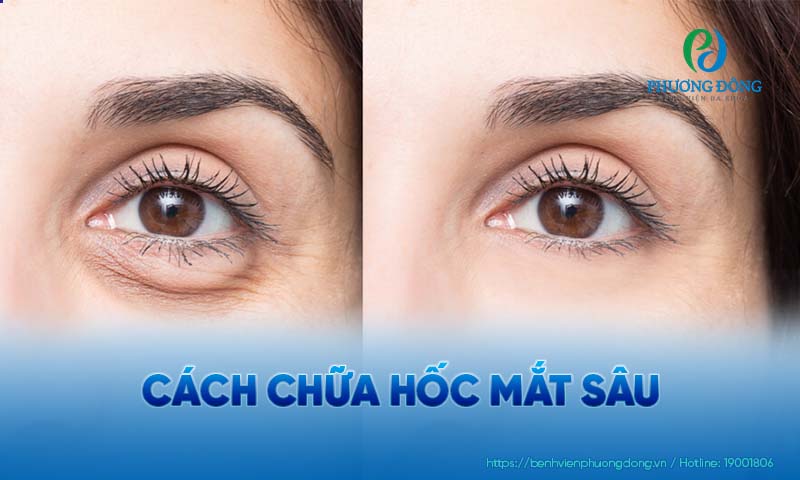 Bạn có thể tìm hiểu các cách chăm sóc để cải thiện chữa hốc mắt sâu tại nhà