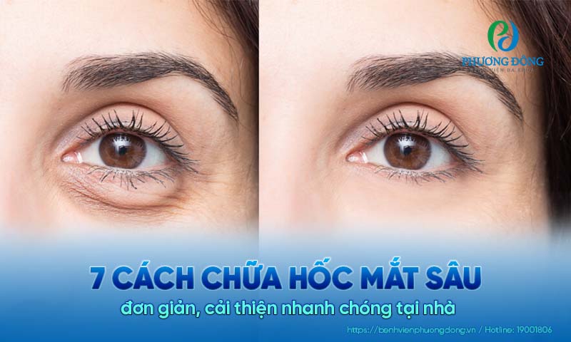7 Cách chữa hốc mắt sâu đơn giản, cải thiện nhanh chóng tại nhà 