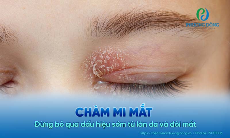 Chàm mi mắt: Đừng bỏ qua dấu hiệu sớm từ làn da và đôi mắt 