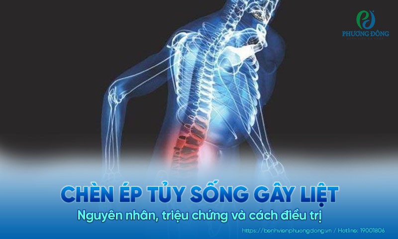 Chèn ép tủy sống gây liệt: Nguyên nhân, triệu chứng và cách điều trị