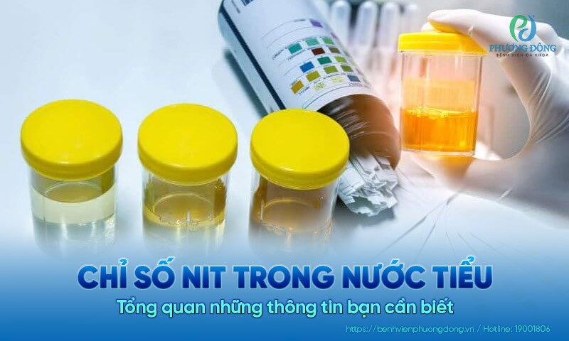 Chỉ số NIT trong nước tiểu: Tổng quan những thông tin bạn cần biết 