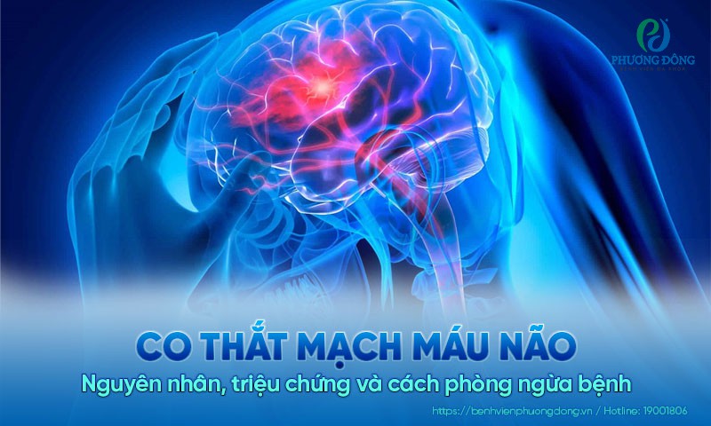Co thắt mạch máu não: Nguyên nhân, triệu chứng và cách phòng ngừa bệnh