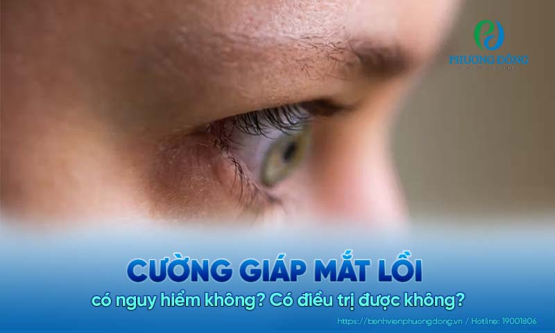 Cường giáp mắt lồi có nguy hiểm không? Có điều trị được không?