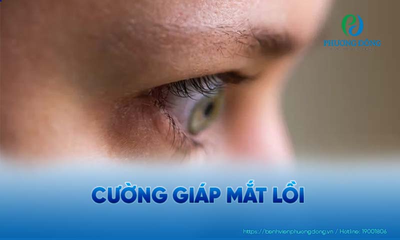 Nhãn cầu bị lồi ra ngoài là biến chứng phổ biến của bệnh cường giáp